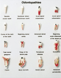 مدل بیماری های دندان